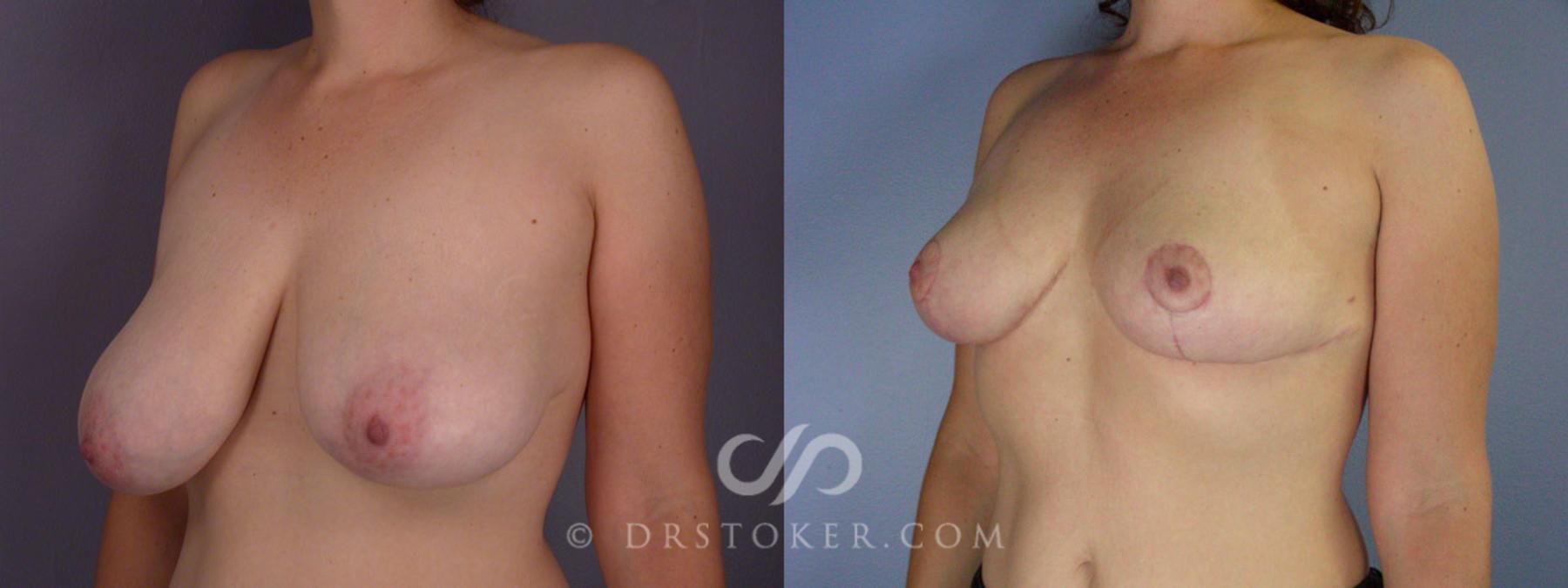 Before & After Breast Reduction (for Women) Case 207 View #3 View in Los Angeles, CA