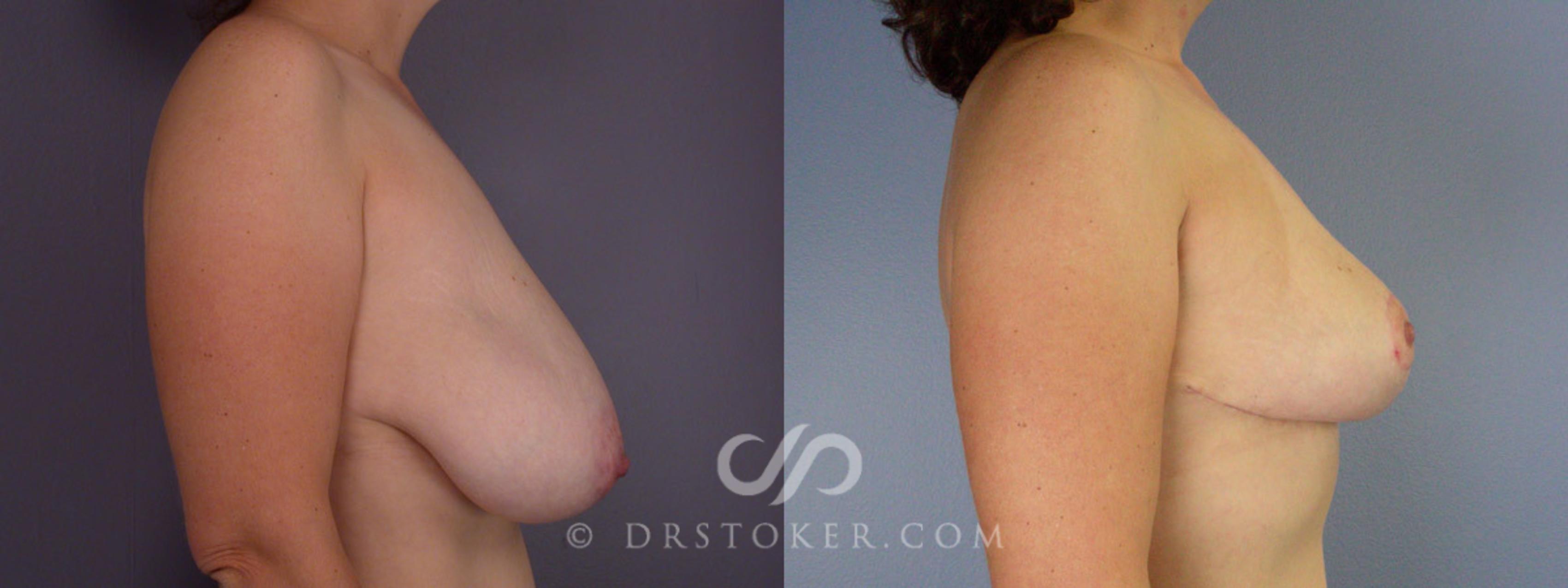 Before & After Breast Asymmetry Correction Case 207 View #4 View in Los Angeles, CA