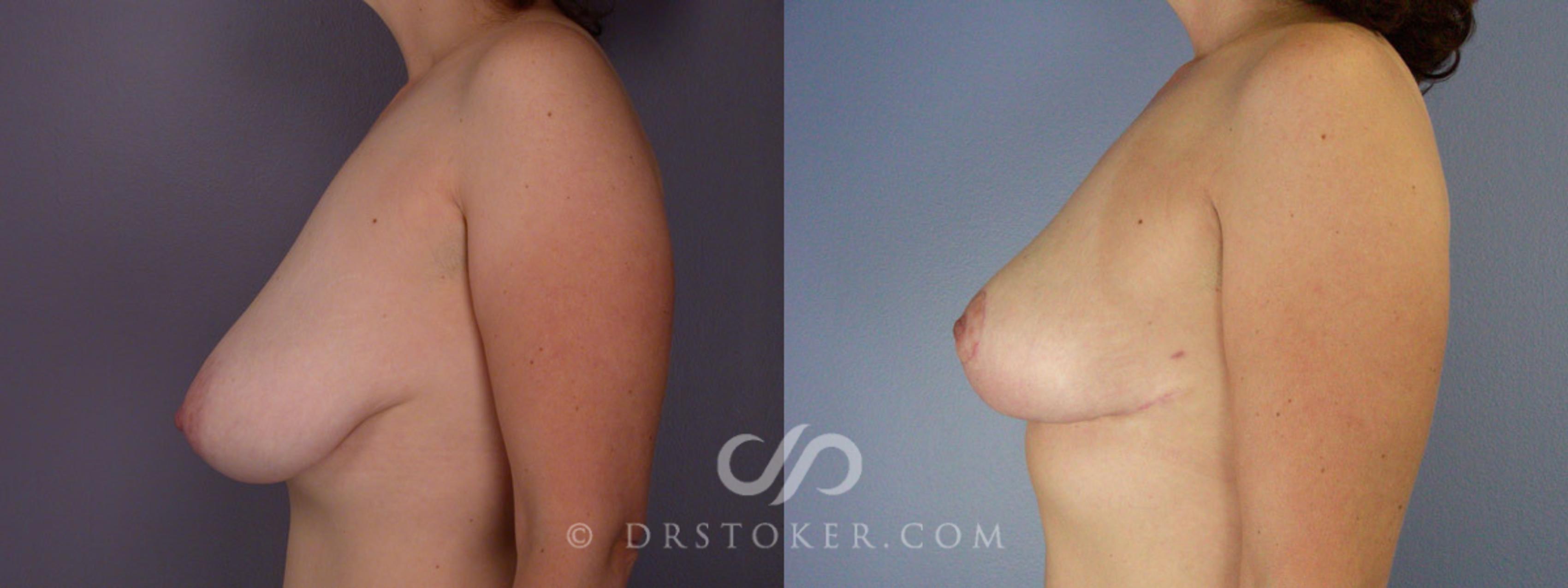 Before & After Breast Asymmetry Correction Case 207 View #5 View in Los Angeles, CA