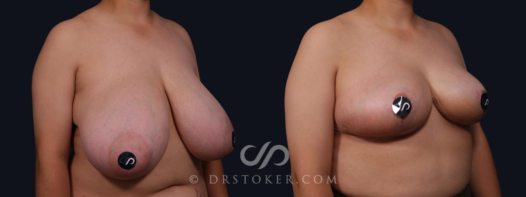 Before & After Breast Reduction (for Women) Case 2075 Right Oblique View in Los Angeles, CA