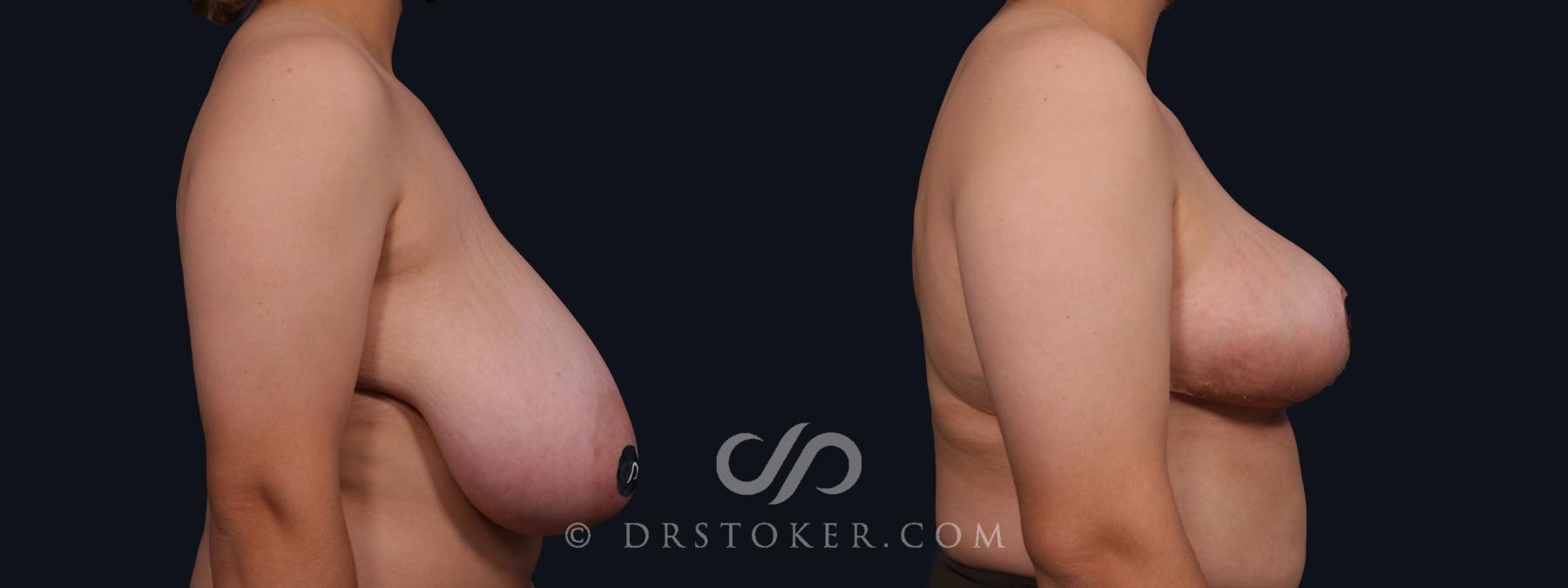Before & After Breast Reduction (for Women) Case 2075 Right Side View in Los Angeles, CA