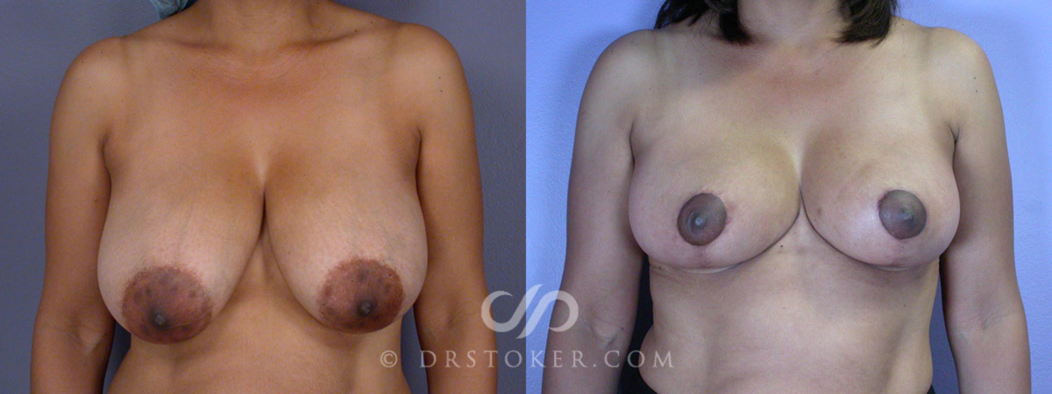 Before & After Breast Reduction (for Women) Case 208 View #1 View in Los Angeles, CA