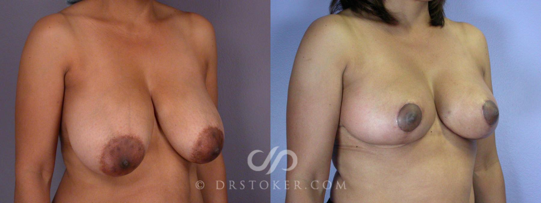 Before & After Breast Reduction (for Women) Case 208 View #2 View in Los Angeles, CA