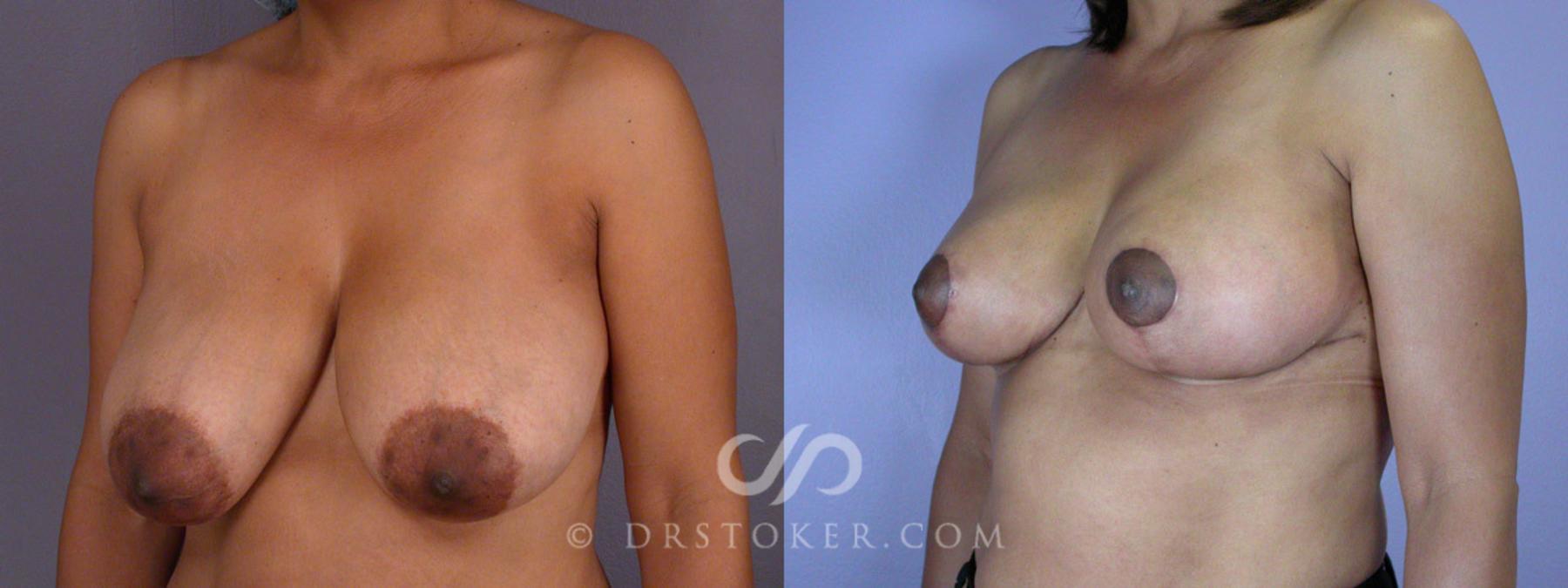 Before & After Breast Reduction (for Women) Case 208 View #3 View in Los Angeles, CA