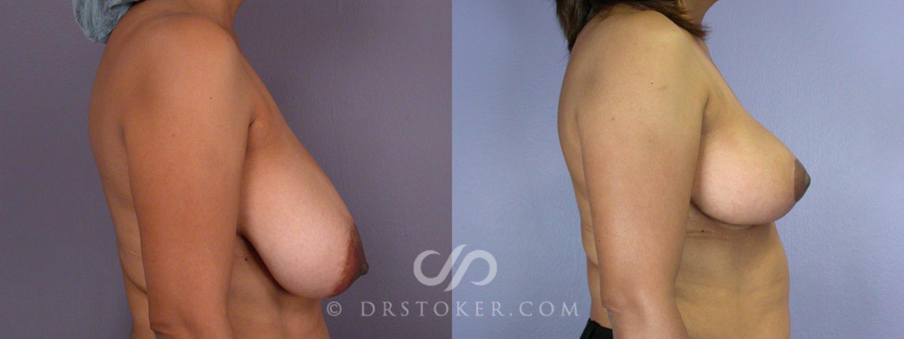 Before & After Breast Reduction (for Women) Case 208 View #4 View in Los Angeles, CA