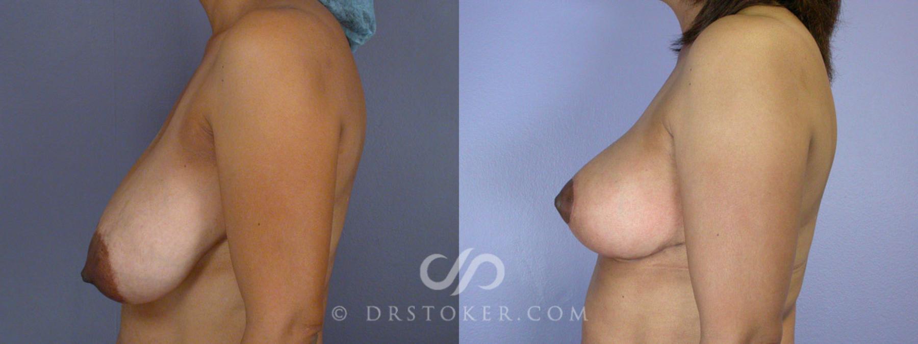 Before & After Breast Reduction (for Women) Case 208 View #5 View in Los Angeles, CA