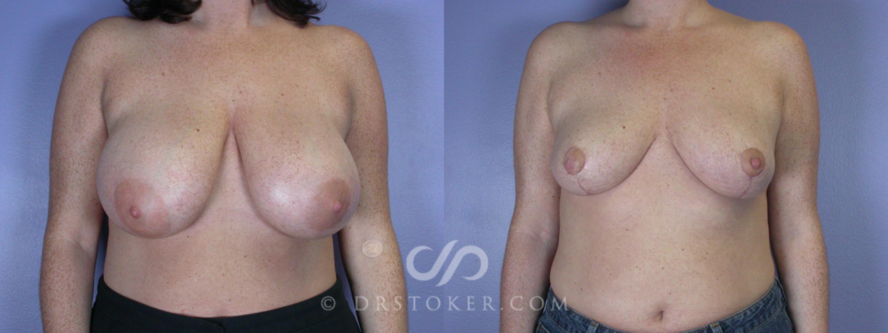 Before & After Breast Reduction (for Women) Case 209 View #1 View in Los Angeles, CA