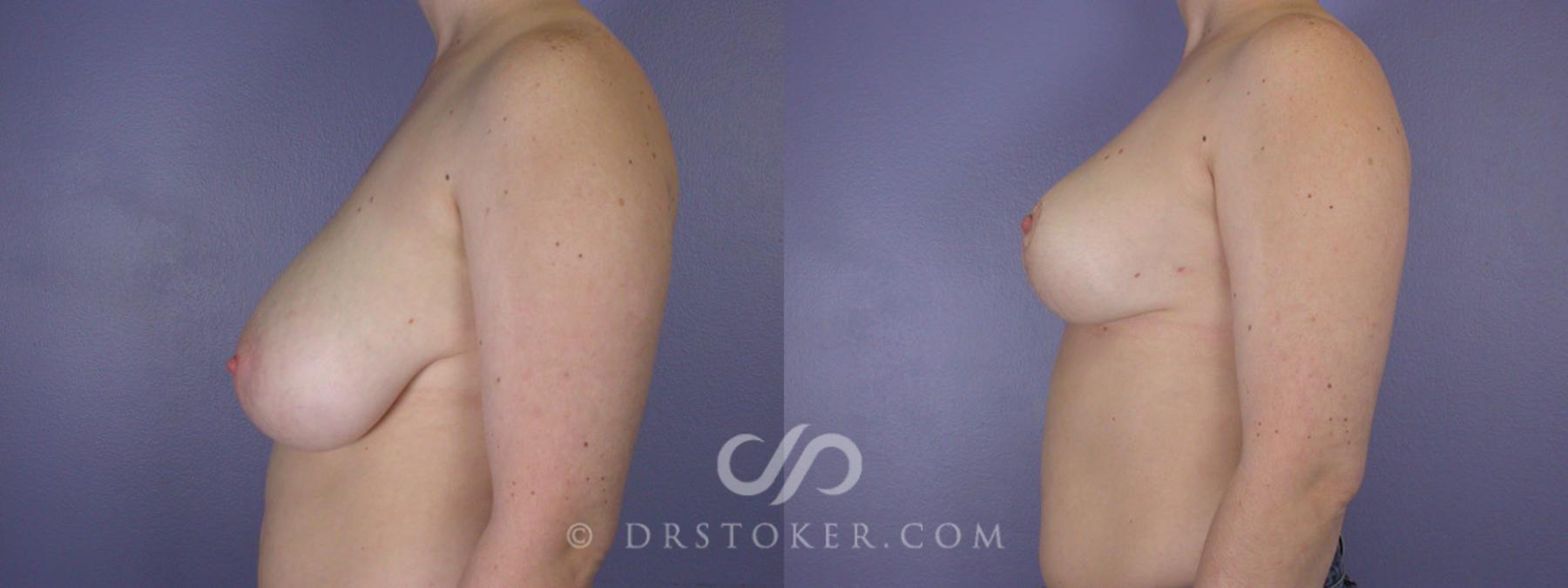 Before & After Breast Reduction (for Women) Case 209 View #5 View in Los Angeles, CA