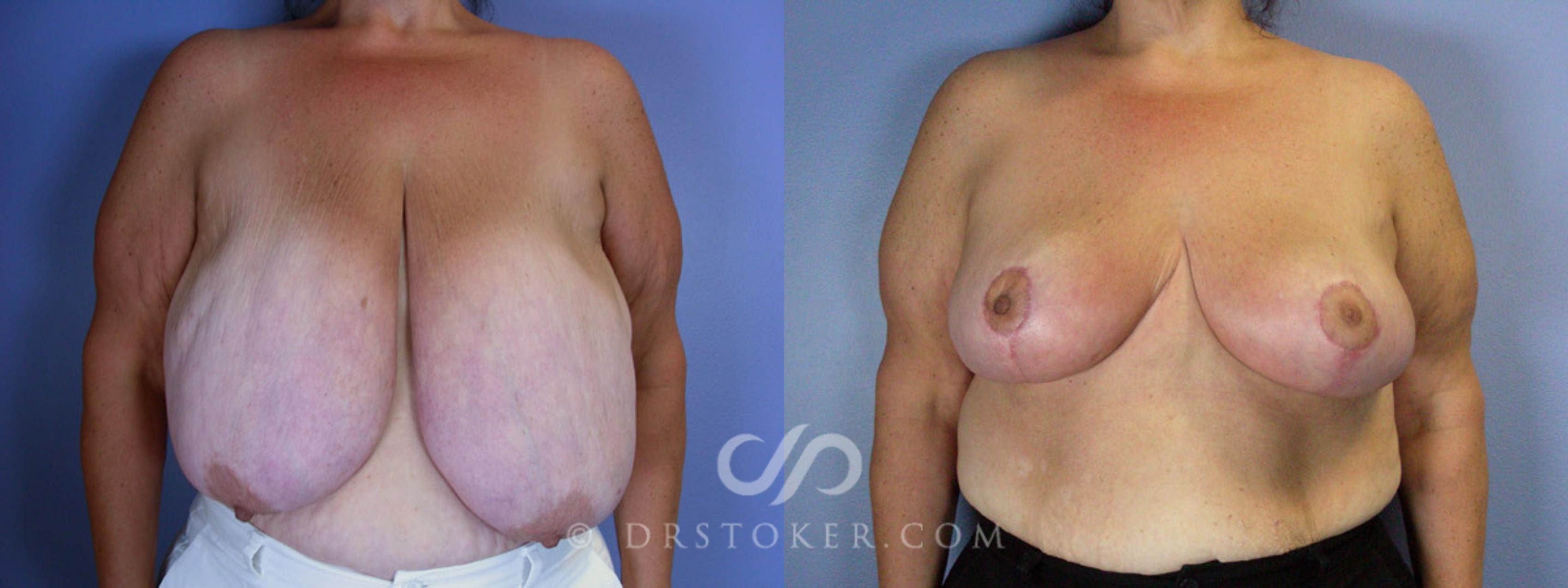 Before & After Breast Reduction (for Women) Case 210 View #1 View in Los Angeles, CA