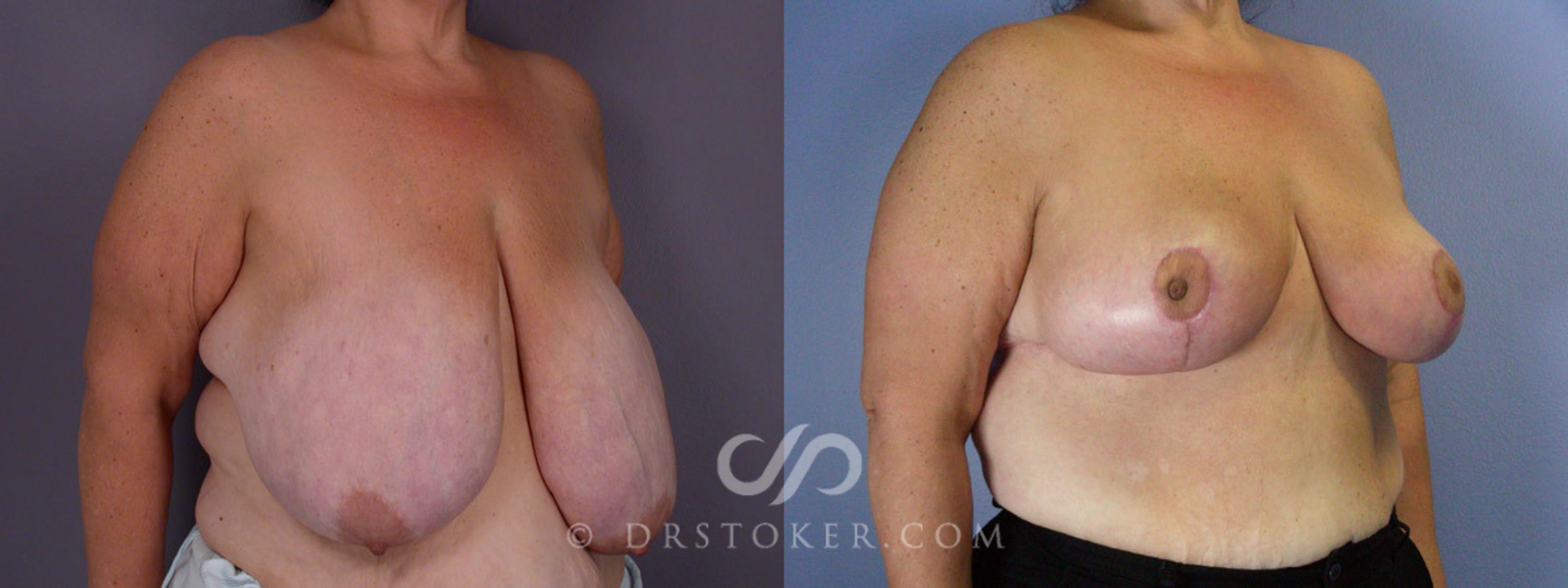 Before & After Breast Reduction (for Women) Case 210 View #2 View in Los Angeles, CA