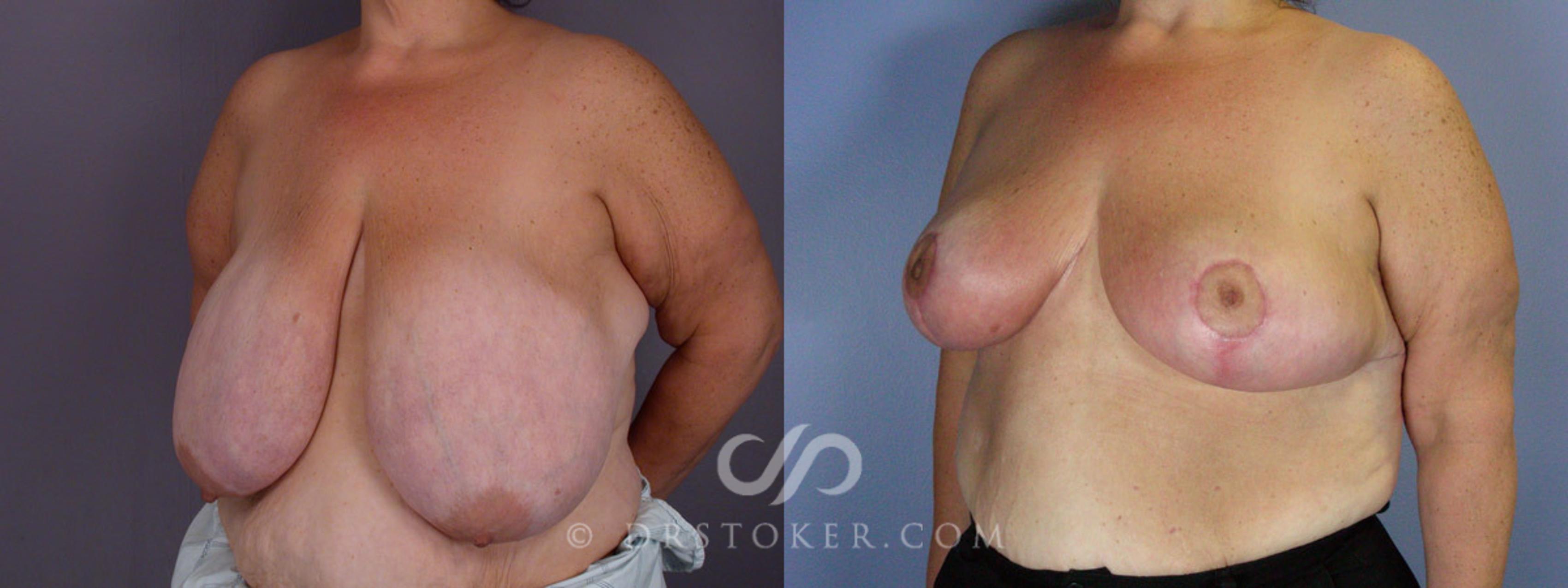 Before & After Breast Reduction (for Women) Case 210 View #3 View in Los Angeles, CA