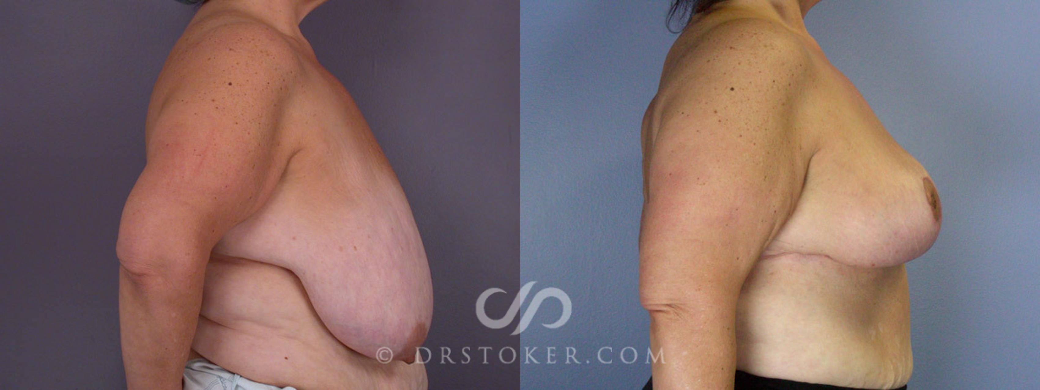 Before & After Breast Reduction (for Women) Case 210 View #4 View in Los Angeles, CA