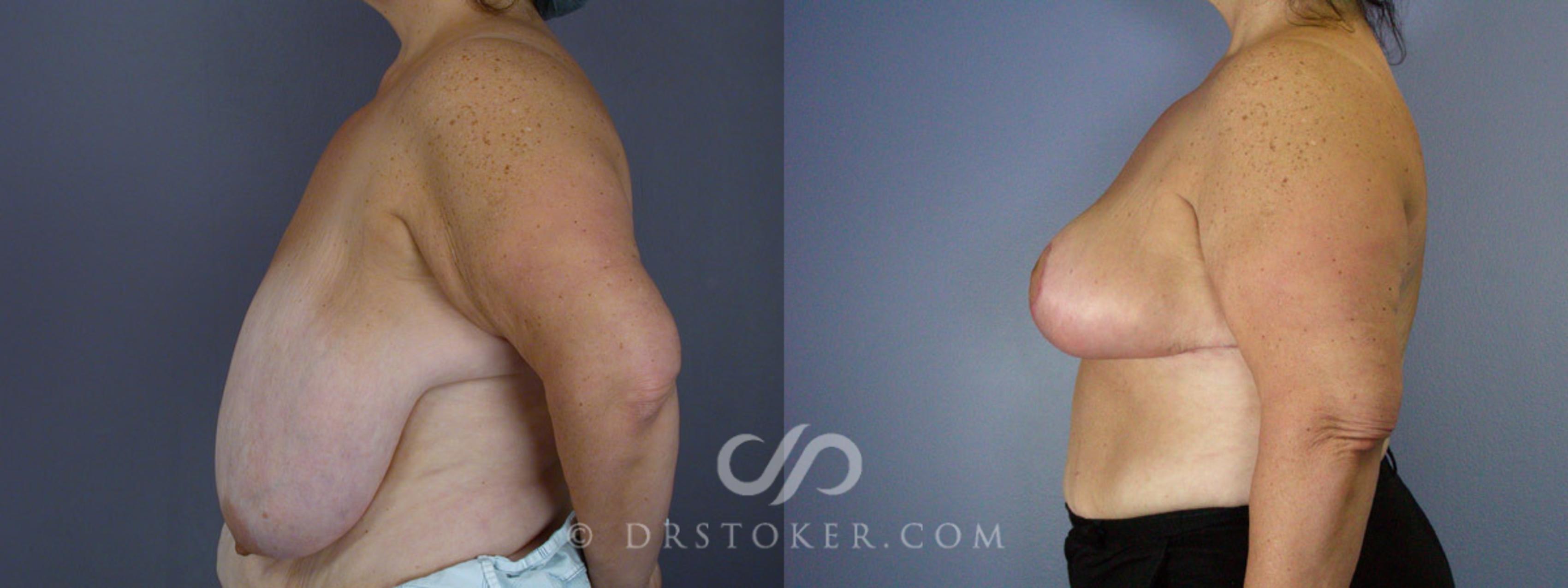 Before & After Breast Reduction (for Women) Case 210 View #5 View in Los Angeles, CA