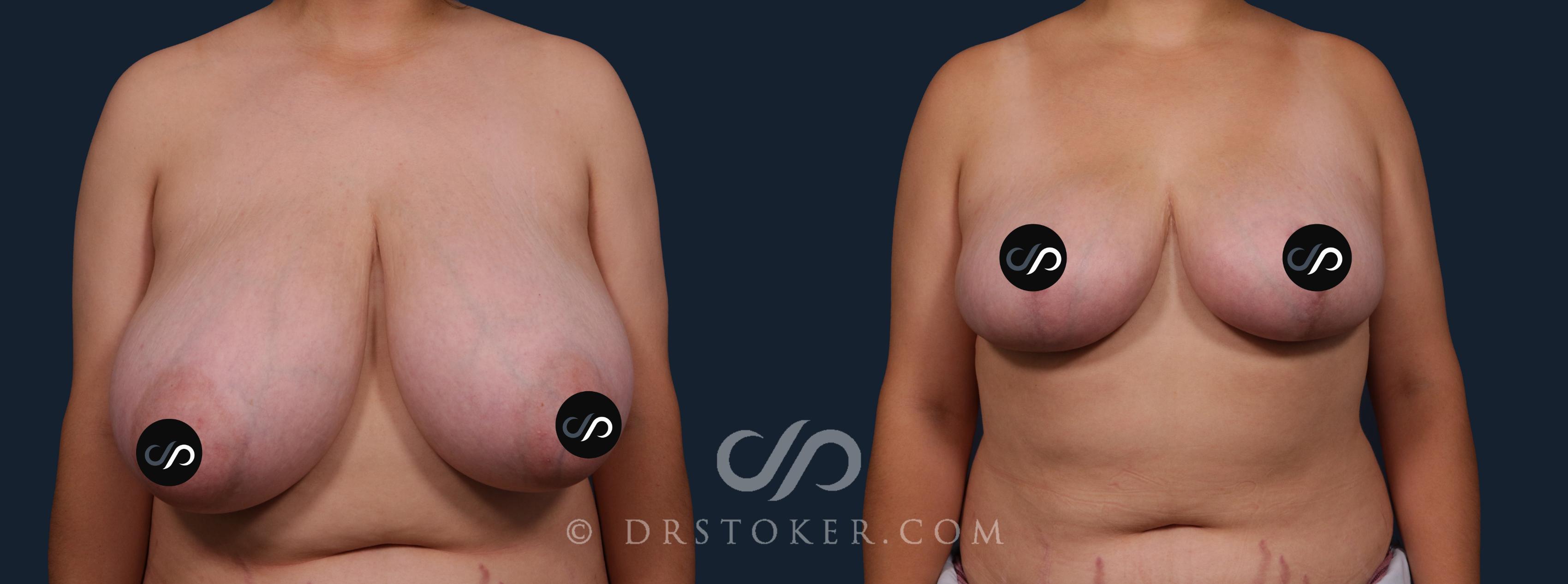 Before & After Breast Reduction (for Women) Case 2105 Front View in Los Angeles, CA