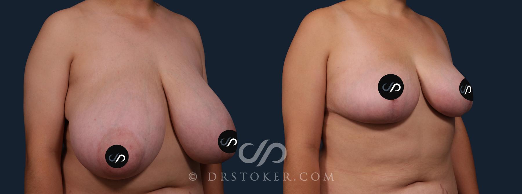 Before & After Breast Reduction (for Women) Case 2105 Left Oblique View in Los Angeles, CA