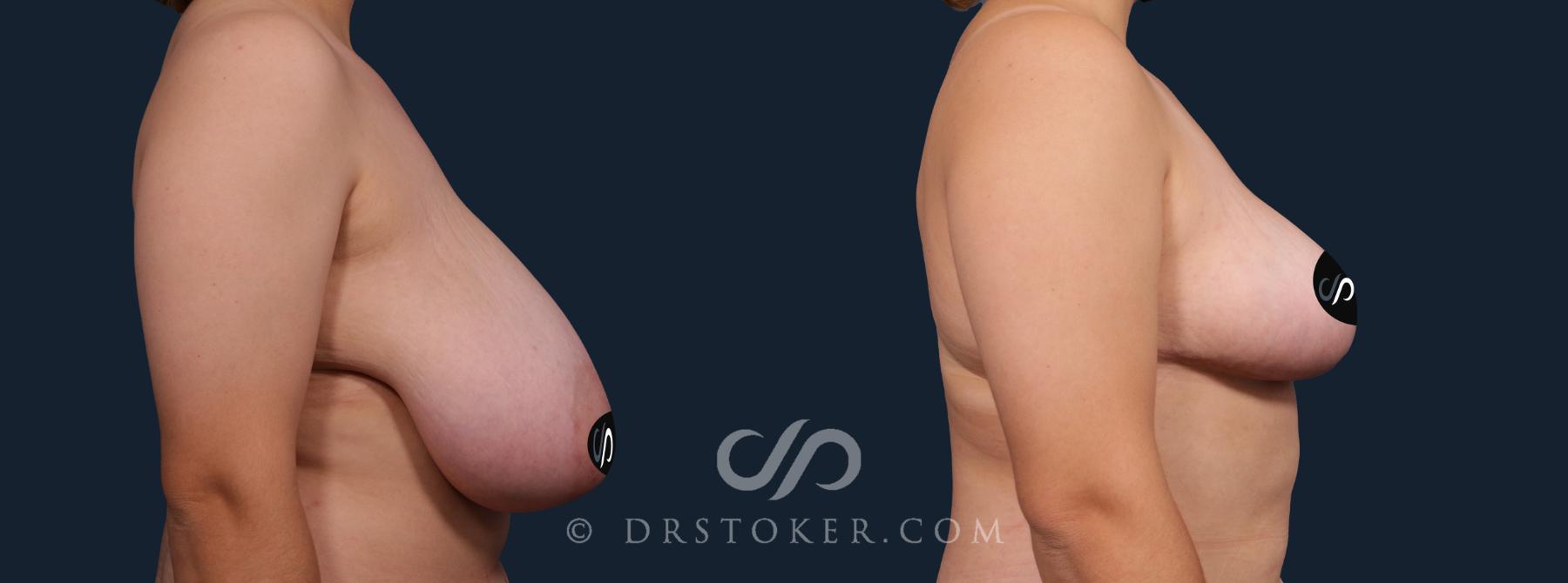 Before & After Breast Reduction (for Women) Case 2105 Right Side View in Los Angeles, CA