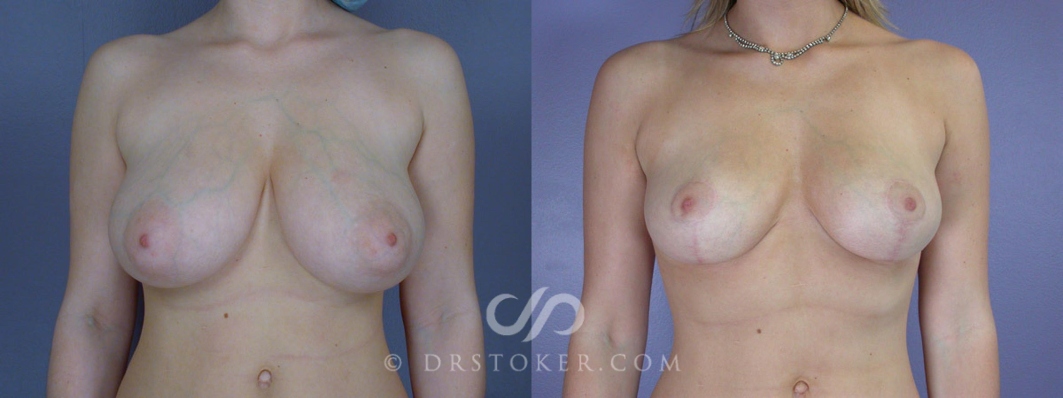 Before & After Breast Reduction (for Women) Case 211 View #1 View in Los Angeles, CA