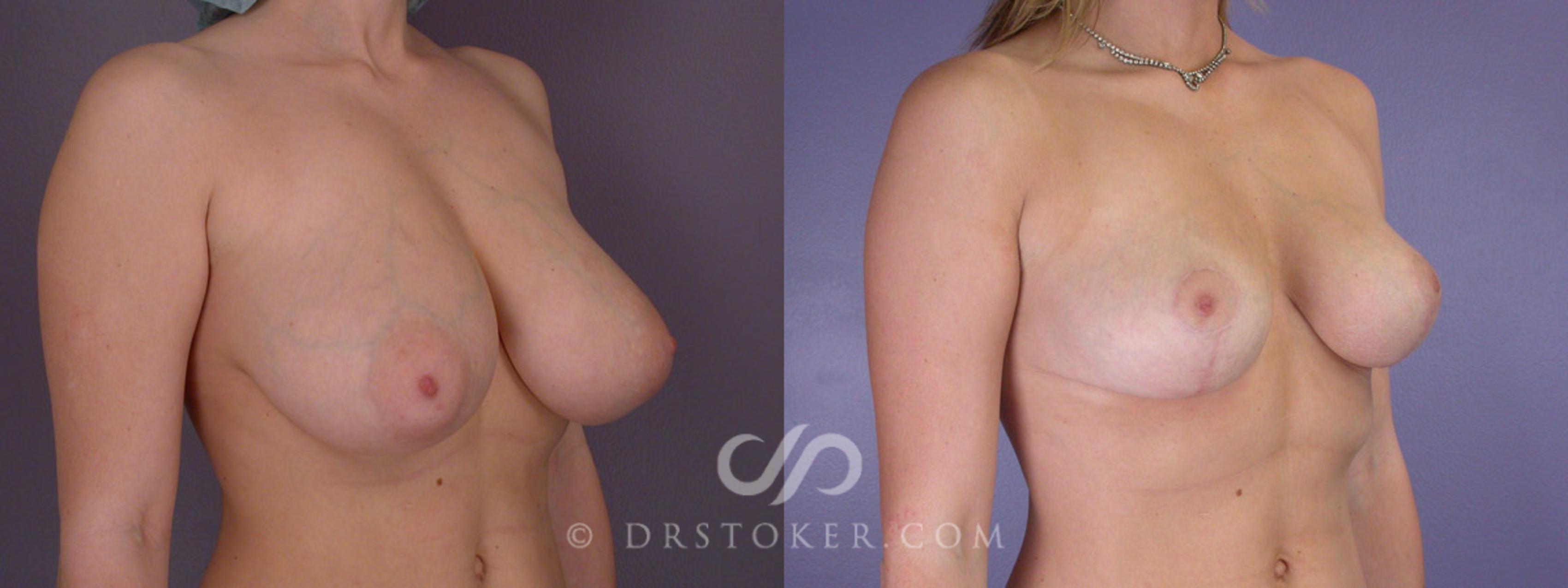 Before & After Breast Reduction (for Women) Case 211 View #2 View in Los Angeles, CA