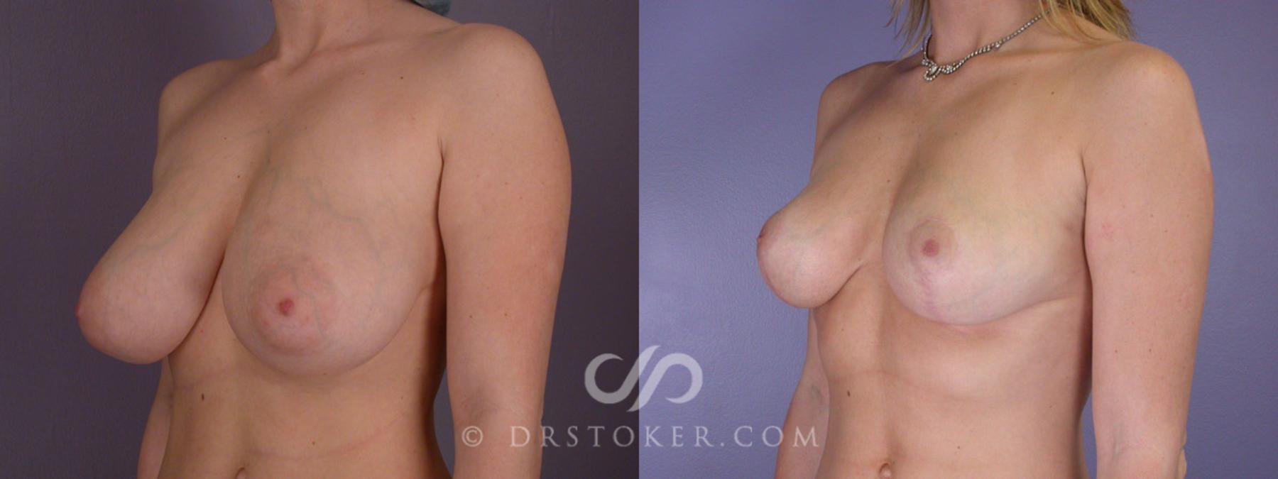 Before & After Breast Reduction (for Women) Case 211 View #3 View in Los Angeles, CA