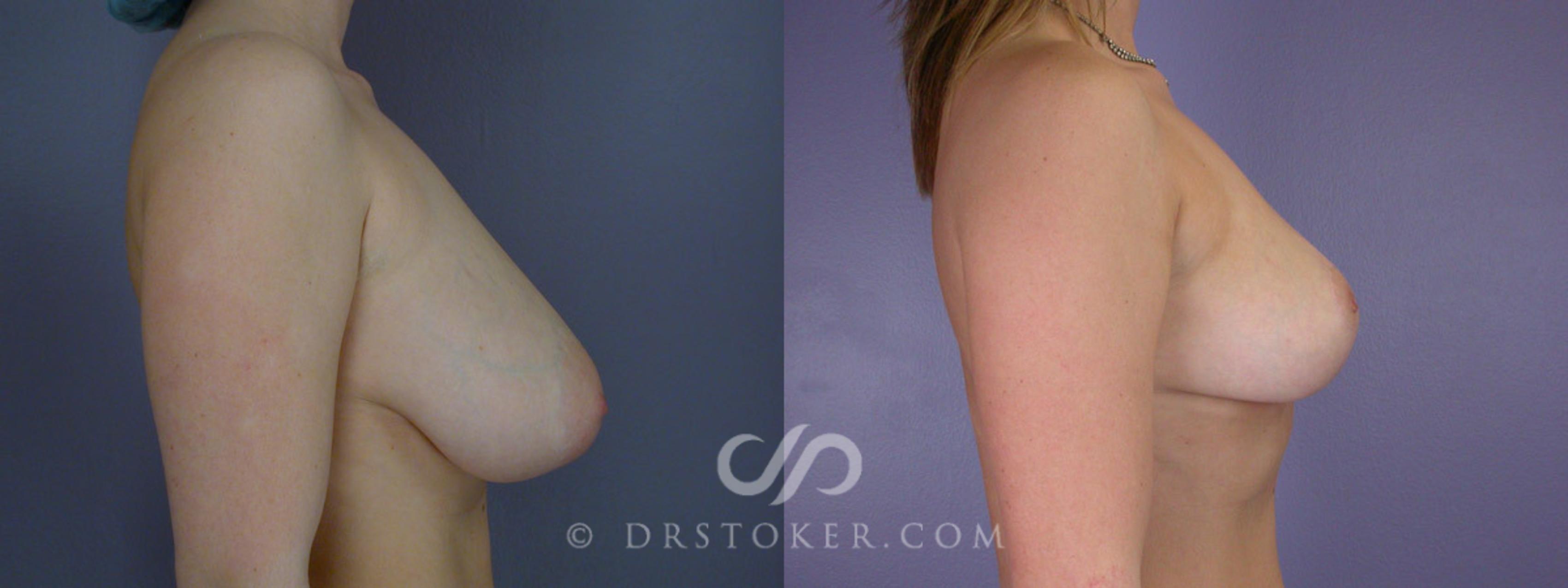 Before & After Breast Reduction (for Women) Case 211 View #4 View in Los Angeles, CA