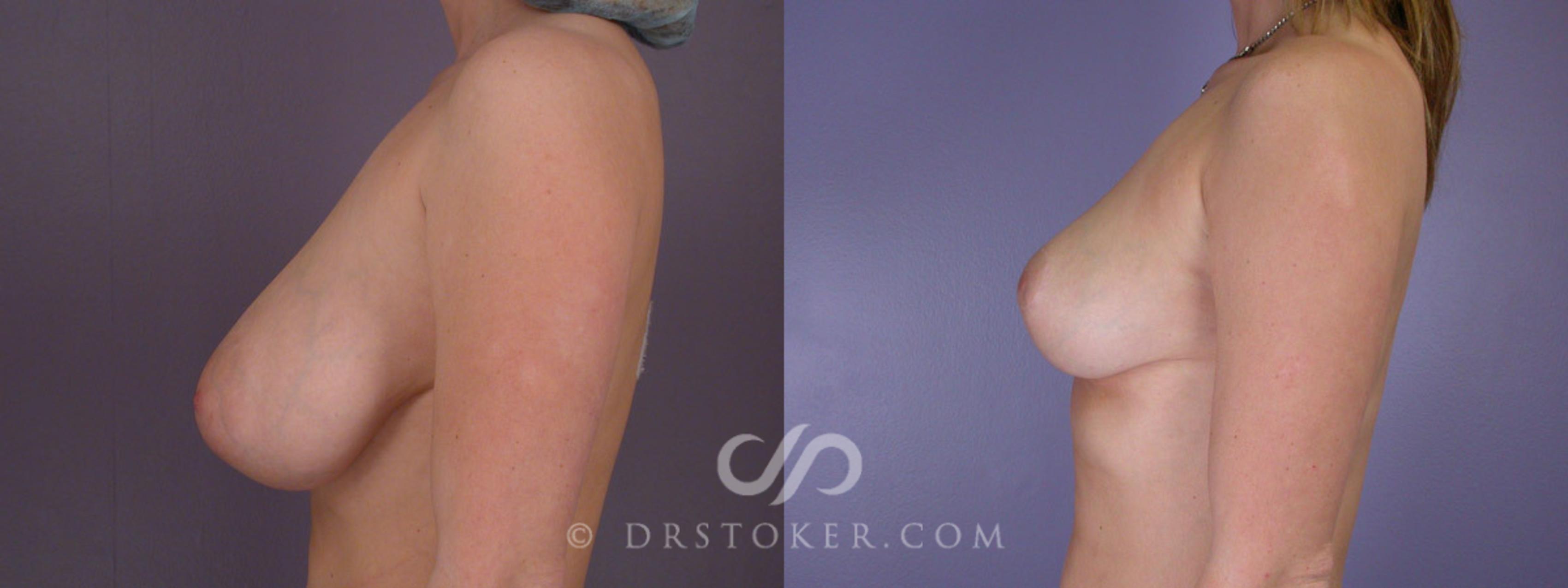 Before & After Breast Reduction (for Women) Case 211 View #5 View in Los Angeles, CA