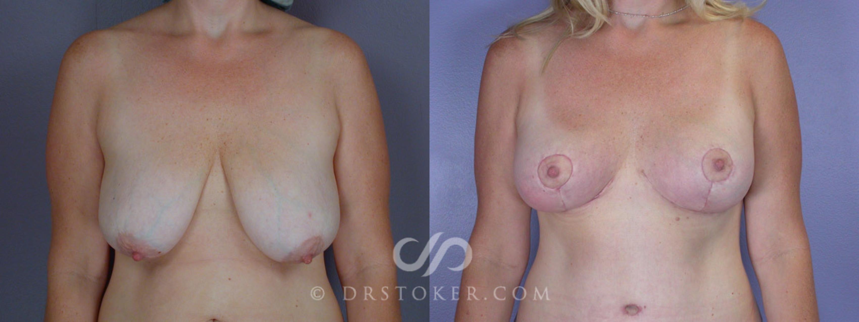 Before & After Breast Lift Case 212 View #1 View in Los Angeles, CA