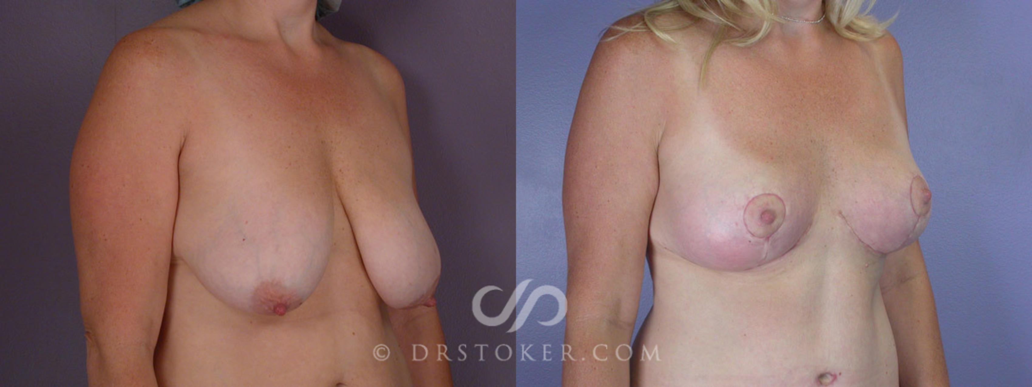 Before & After Breast Lift Case 212 View #2 View in Los Angeles, CA