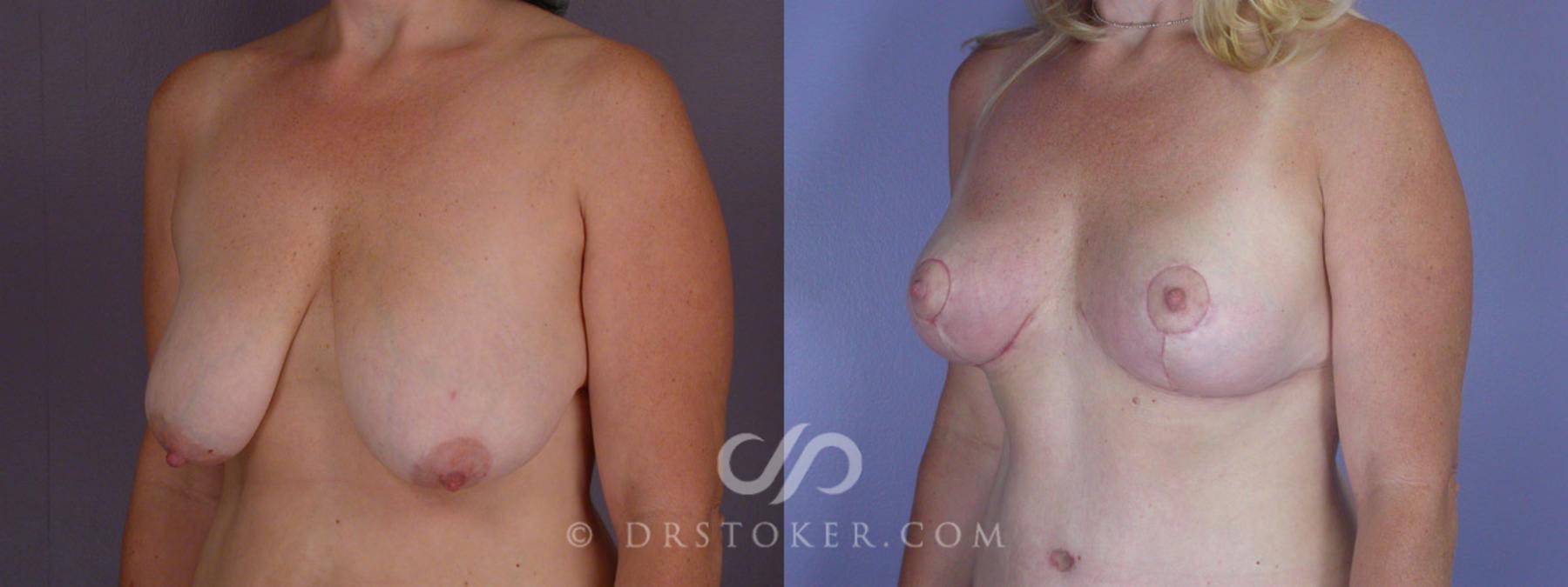 Before & After Breast Reduction (for Women) Case 212 View #3 View in Los Angeles, CA