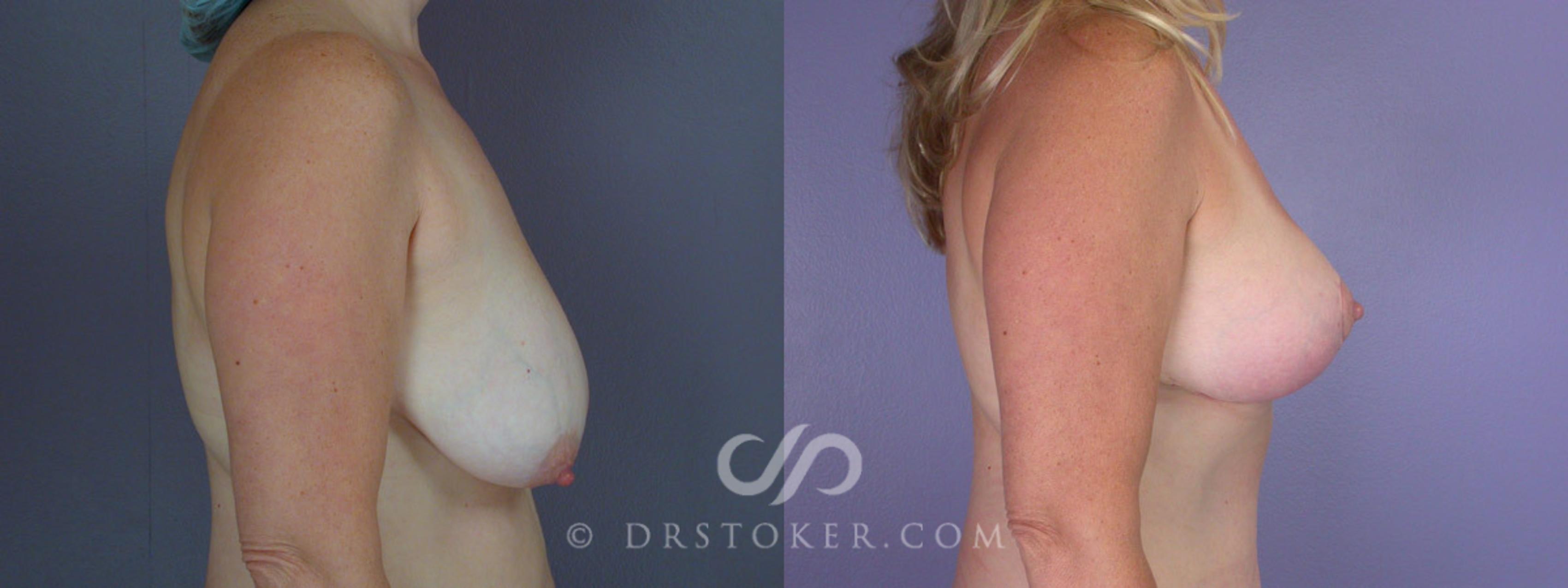 Before & After Breast Lift Case 212 View #4 View in Los Angeles, CA