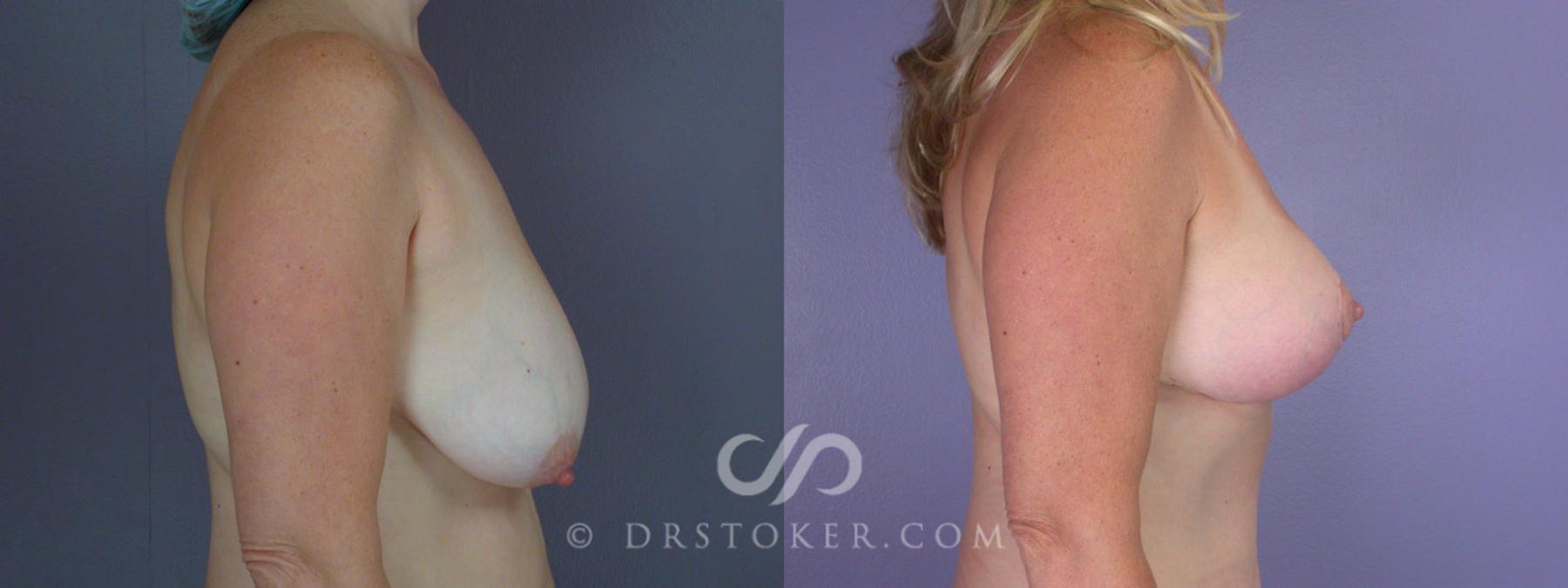 Before & After Breast Lift Case 212 View #4 View in Los Angeles, CA