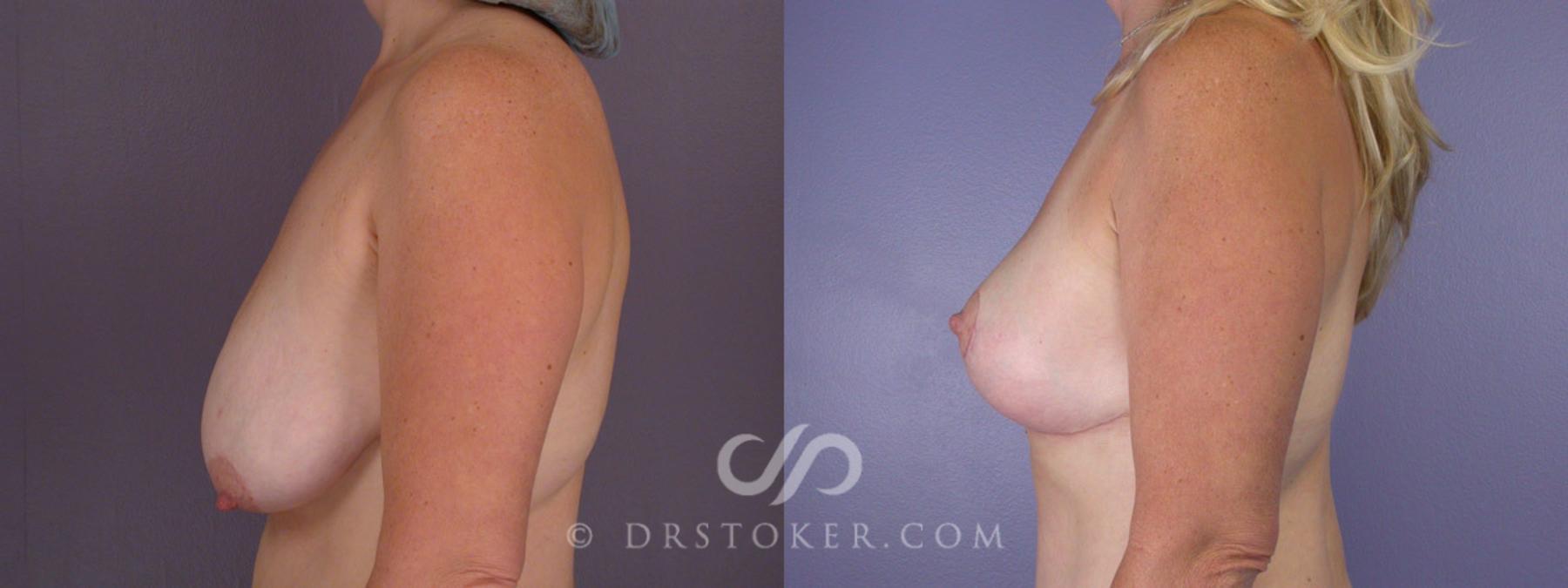 Before & After Breast Reduction (for Women) Case 212 View #5 View in Los Angeles, CA