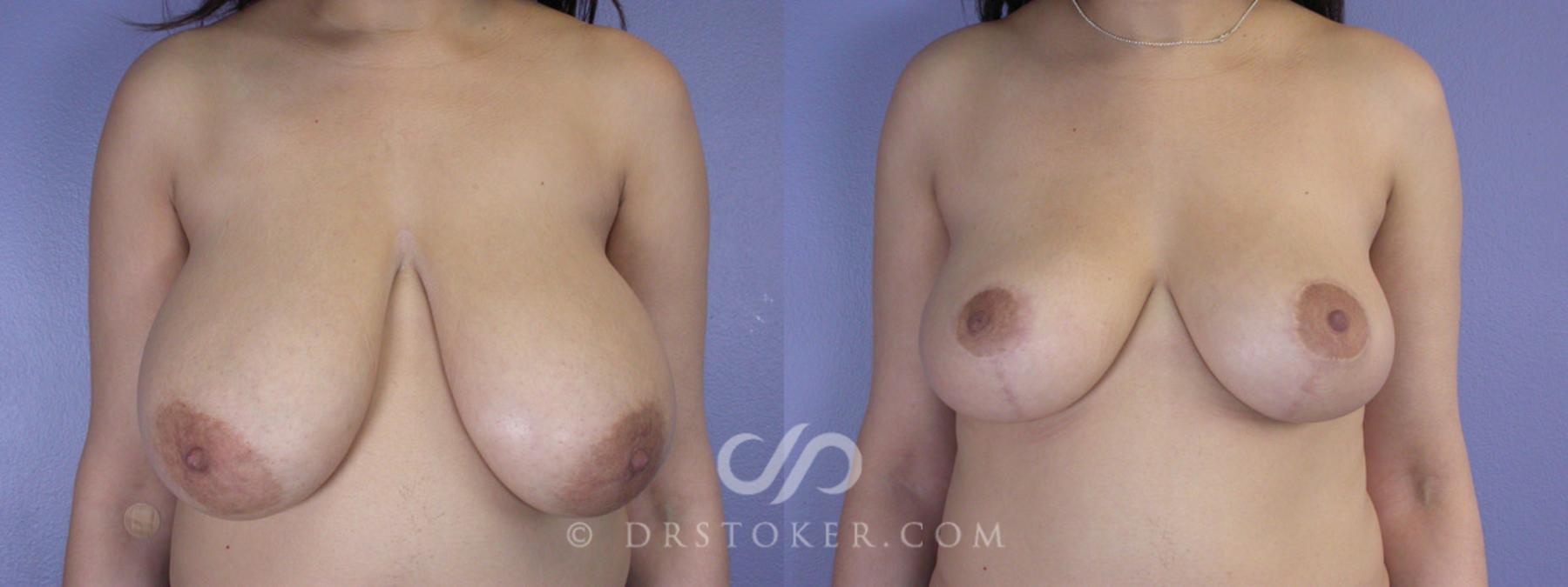 Before & After Breast Reduction (for Women) Case 213 View #1 View in Los Angeles, CA