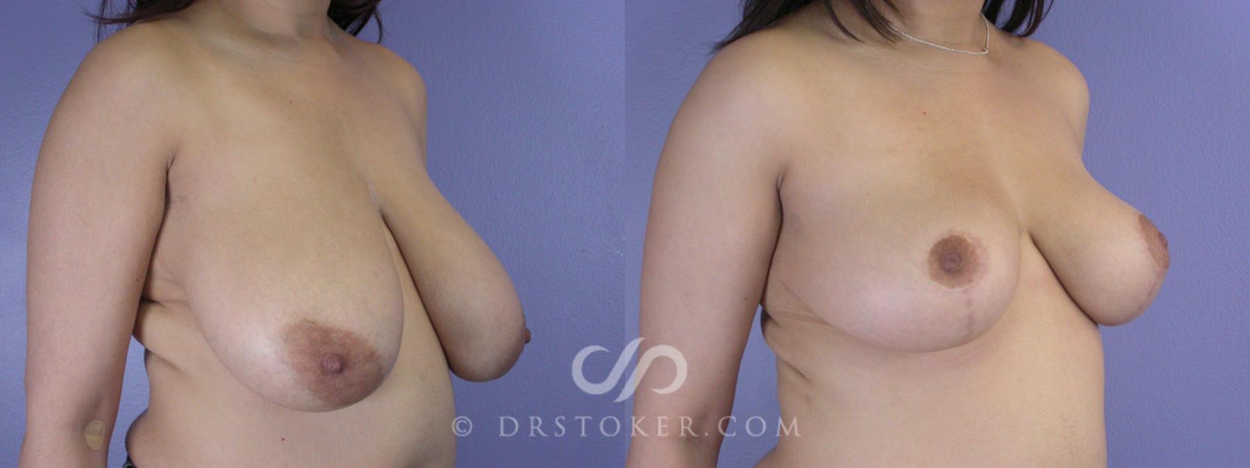 Before & After Breast Reduction (for Women) Case 213 View #2 View in Los Angeles, CA