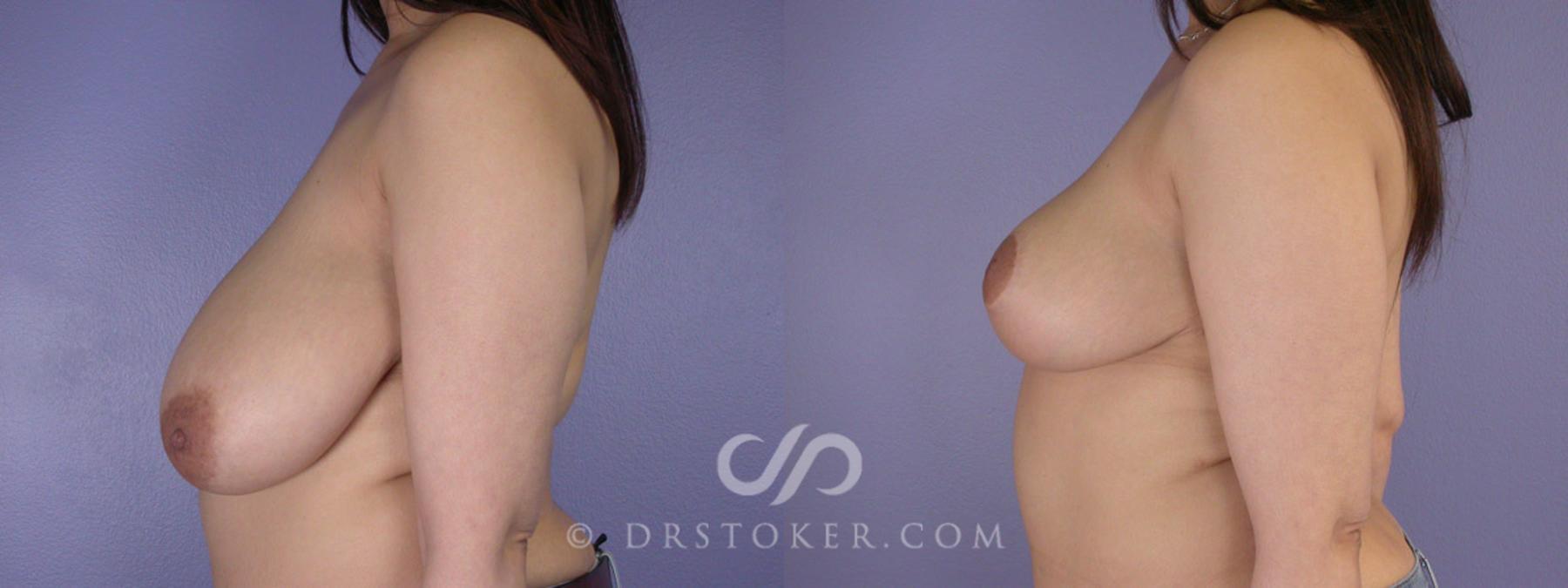 Before & After Breast Reduction (for Women) Case 213 View #5 View in Los Angeles, CA