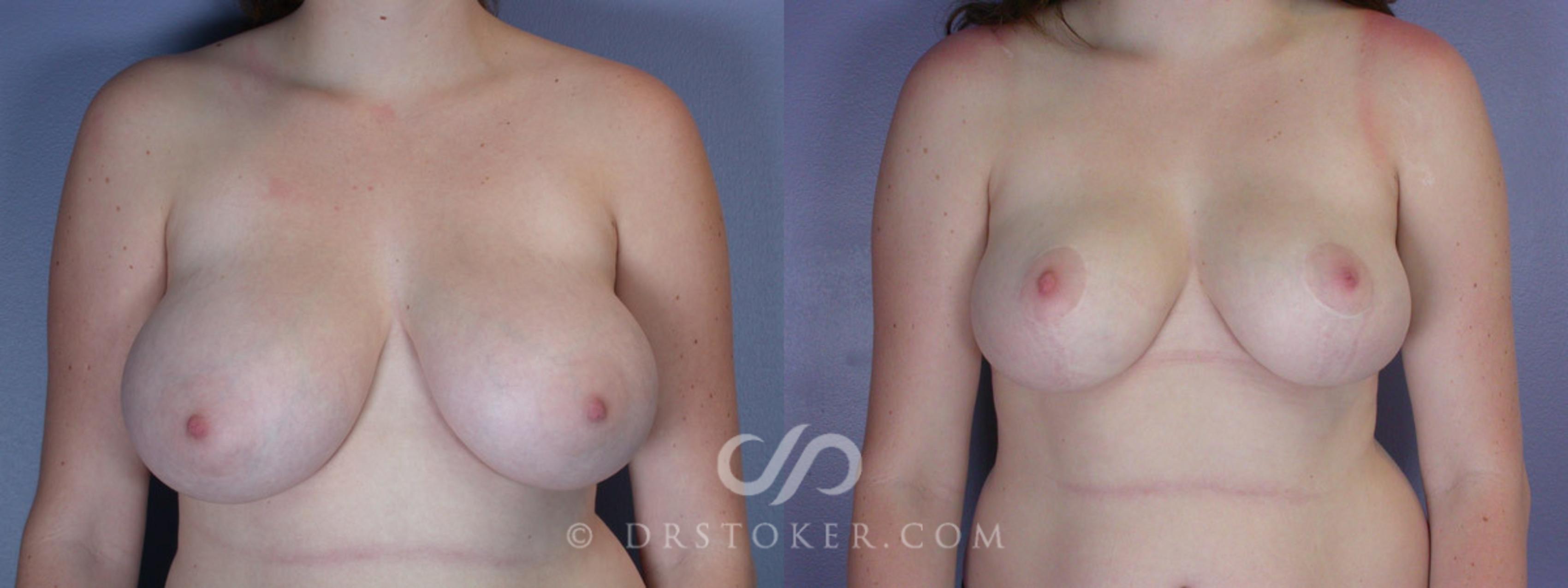 Before & After Breast Reduction (for Women) Case 214 View #1 View in Los Angeles, CA