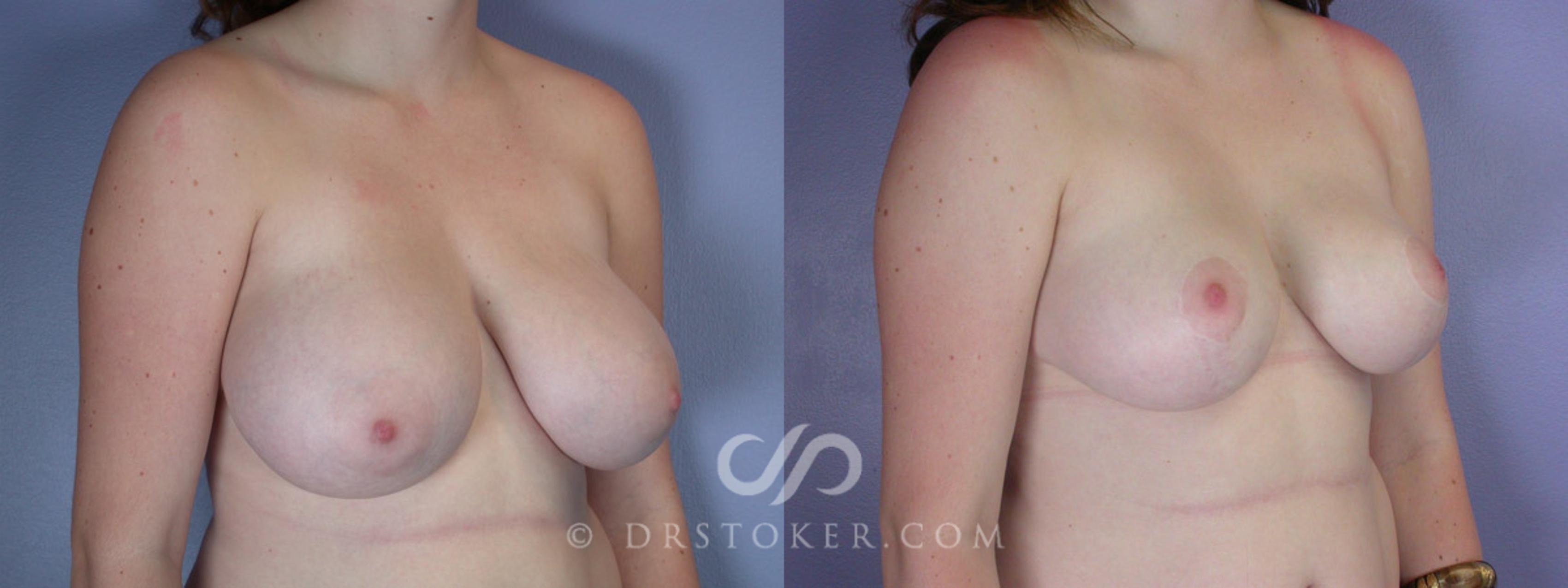 Before & After Breast Reduction (for Women) Case 214 View #2 View in Los Angeles, CA