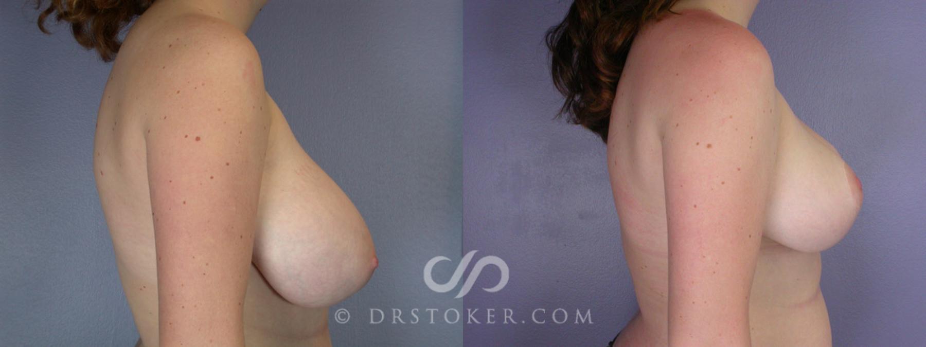 Before & After Breast Reduction (for Women) Case 214 View #4 View in Los Angeles, CA