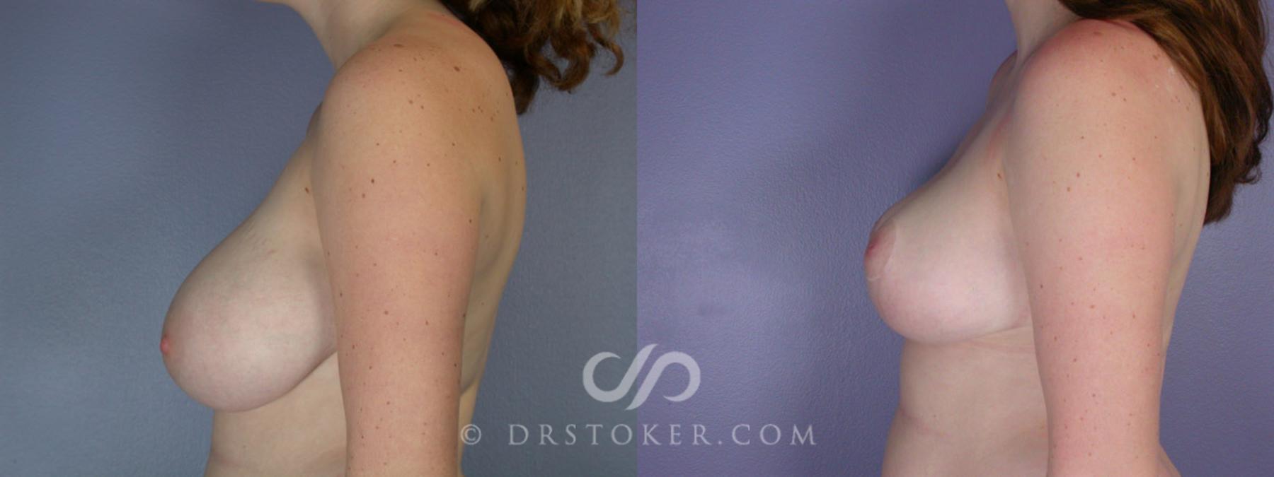 Before & After Breast Reduction (for Women) Case 214 View #5 View in Los Angeles, CA