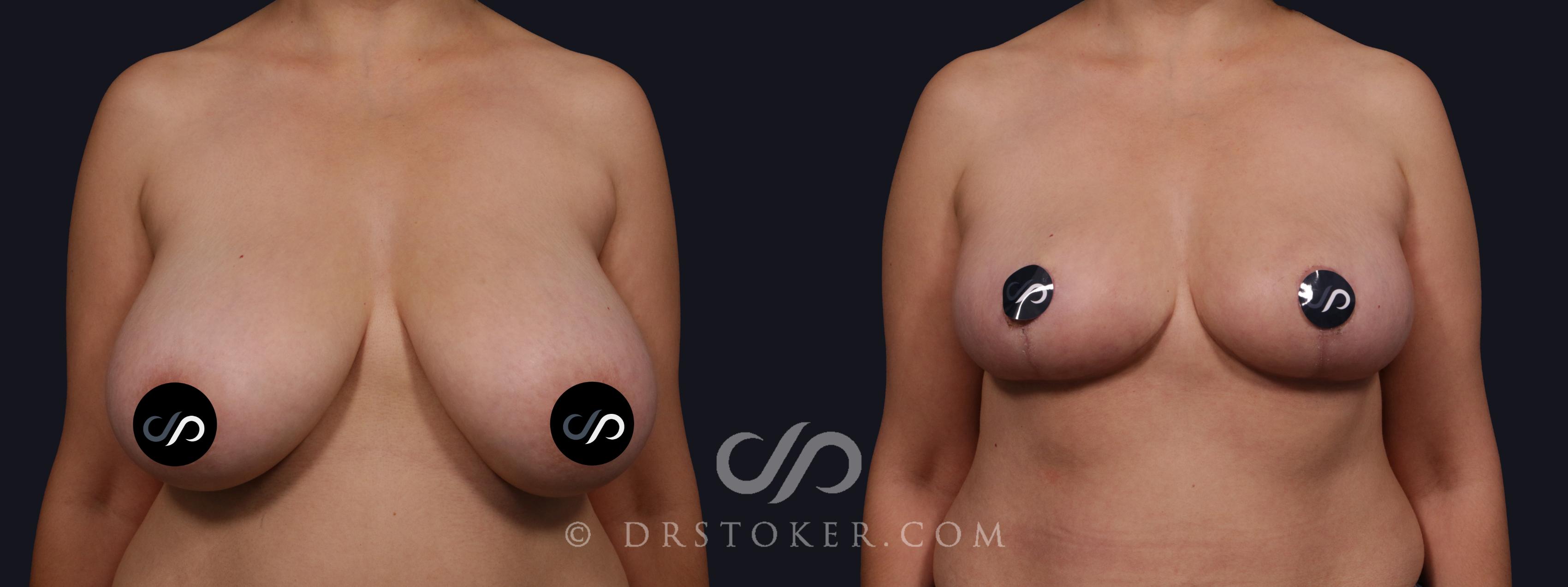 Before & After Breast Reduction (for Women) Case 2141 Front View in Los Angeles, CA