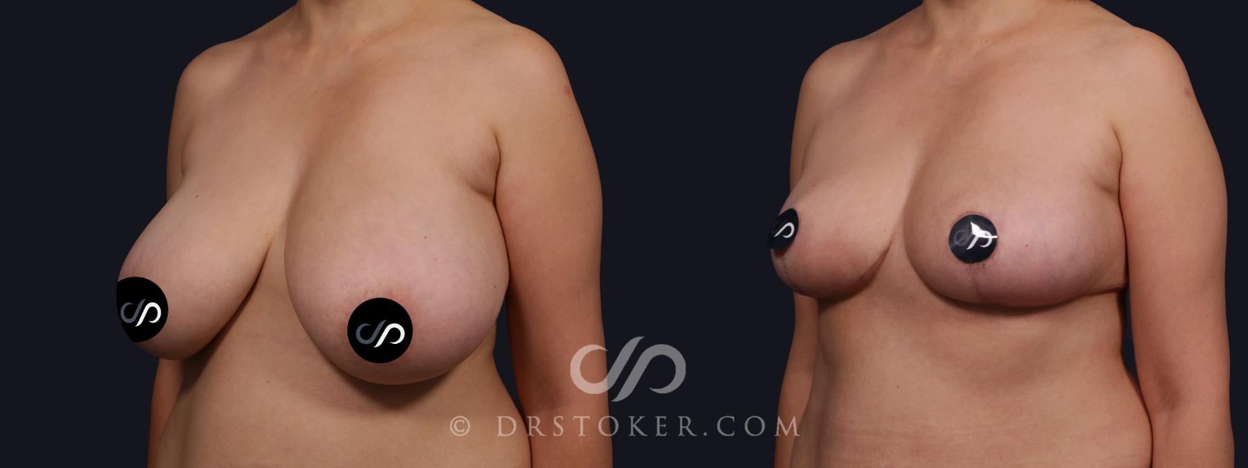 Before & After Breast Reduction (for Women) Case 2141 Left Oblique View in Los Angeles, CA