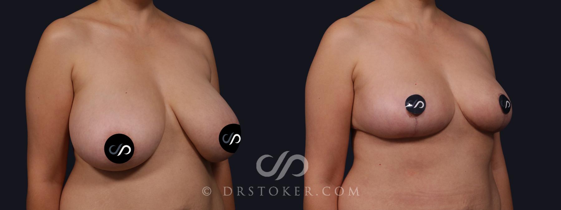 Before & After Breast Reduction (for Women) Case 2141 Right Oblique View in Los Angeles, CA