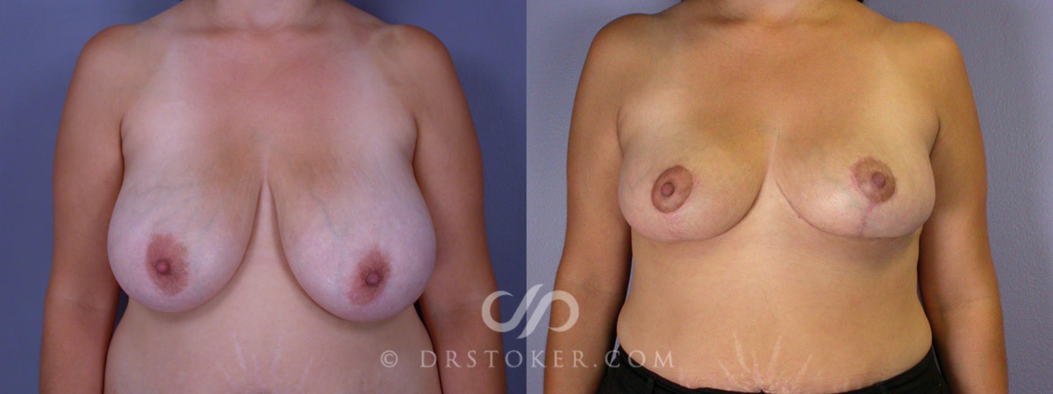 Before & After Breast Reduction (for Women) Case 215 View #1 View in Los Angeles, CA