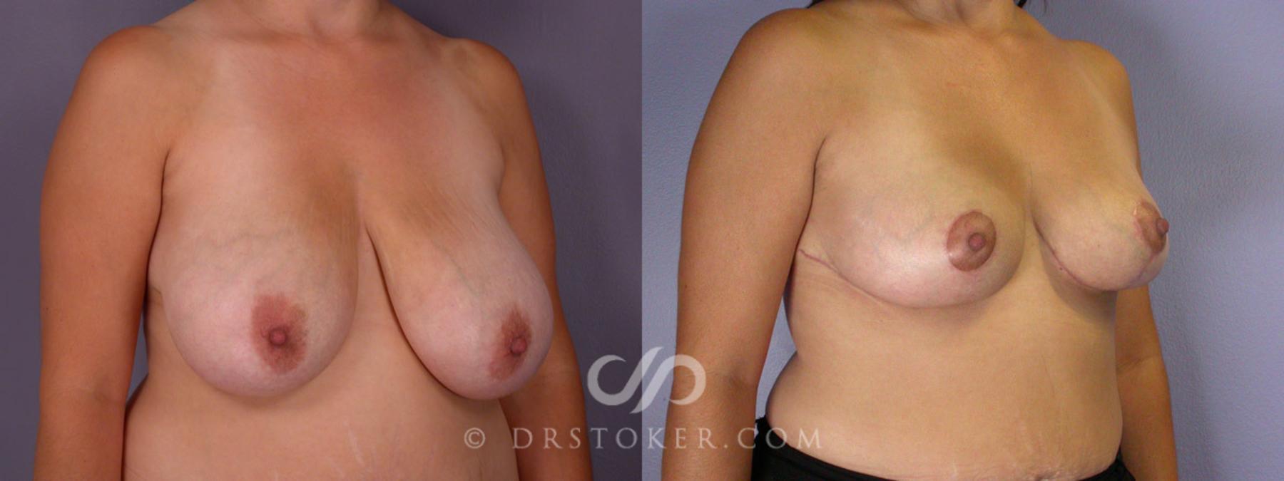 Before & After Breast Reduction (for Women) Case 215 View #2 View in Los Angeles, CA