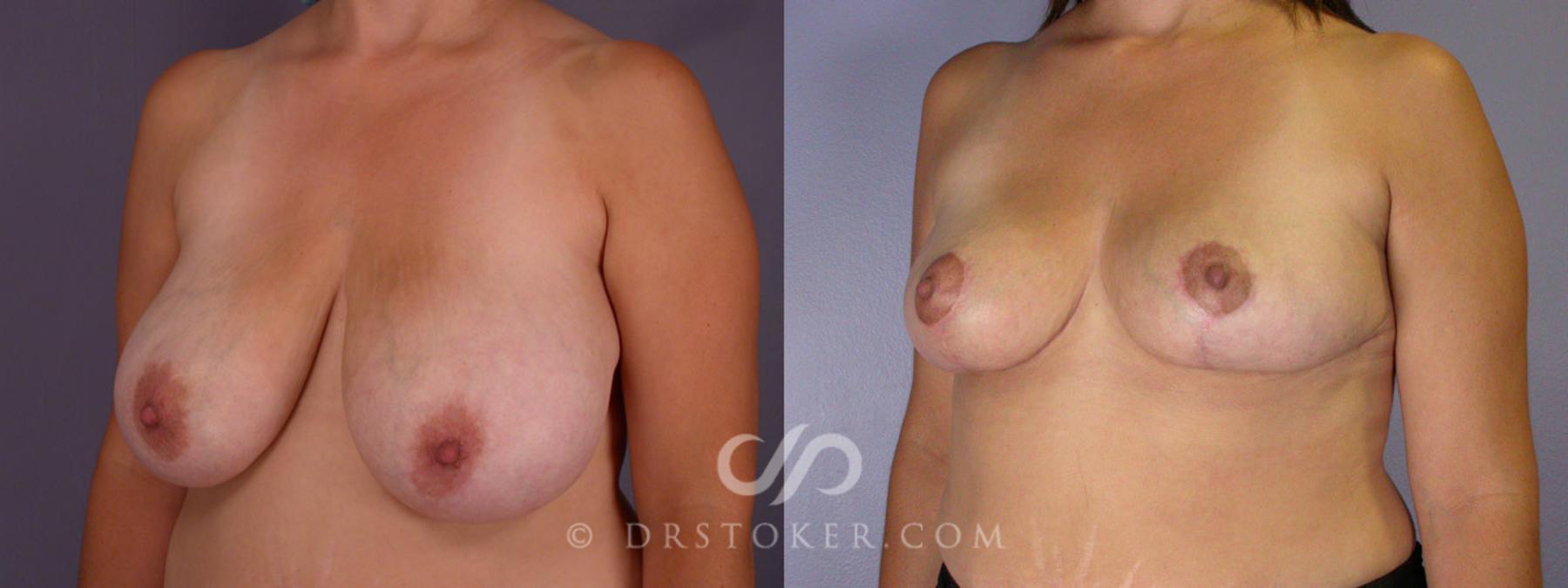 Before & After Breast Reduction (for Women) Case 215 View #3 View in Los Angeles, CA