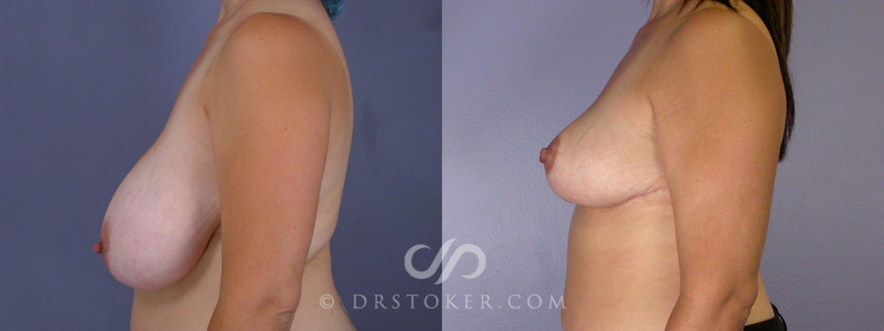 Before & After Breast Reduction (for Women) Case 215 View #5 View in Los Angeles, CA