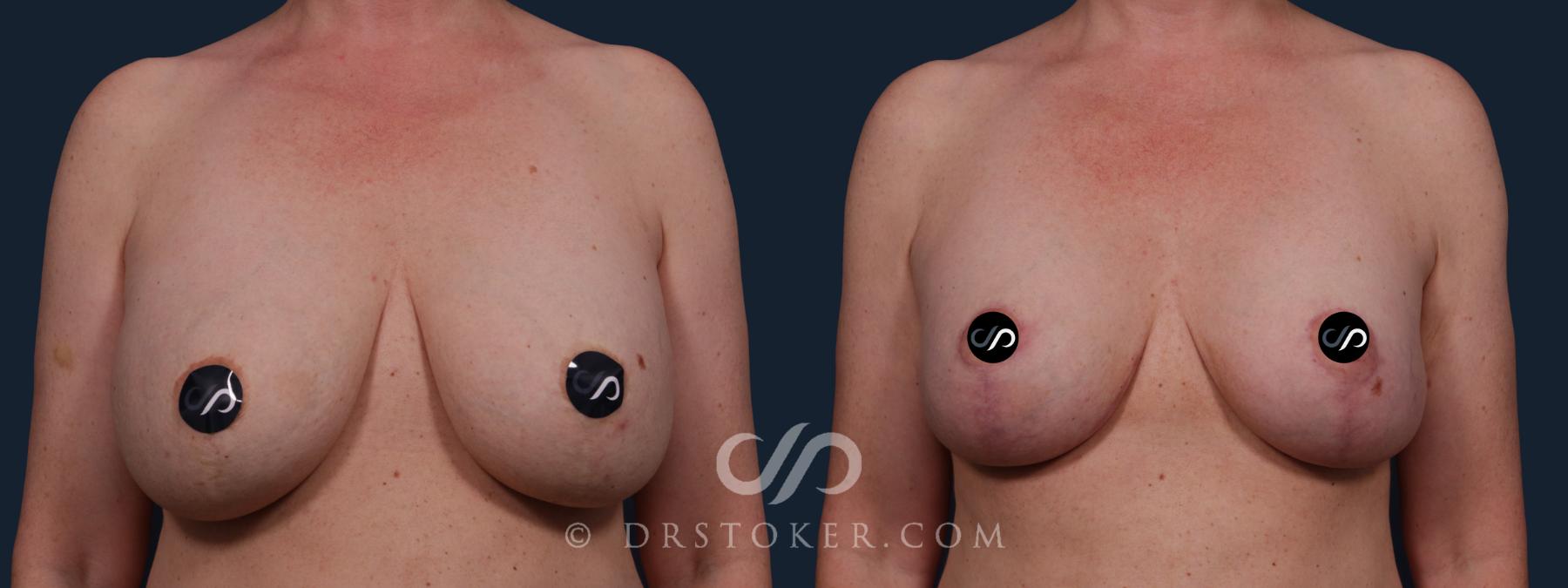 Before & After Breast Reduction (for Women) Case 2153 Front View in Los Angeles, CA