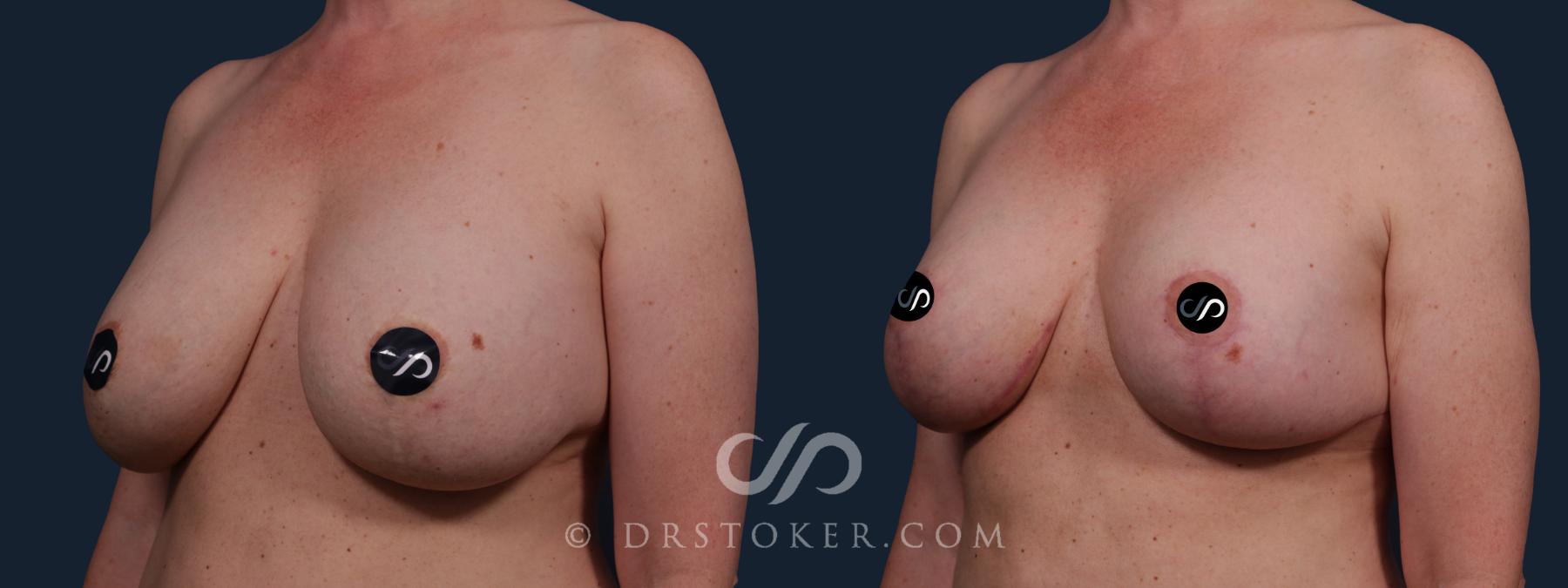 Before & After Breast Reduction (for Women) Case 2153 Left Oblique View in Los Angeles, CA