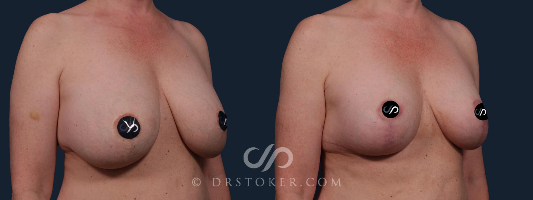 Before & After Breast Reduction (for Women) Case 2153 Right Oblique View in Los Angeles, CA