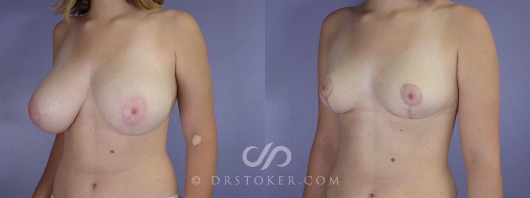 Before & After Breast Reduction (for Women) Case 216 View #3 View in Los Angeles, CA
