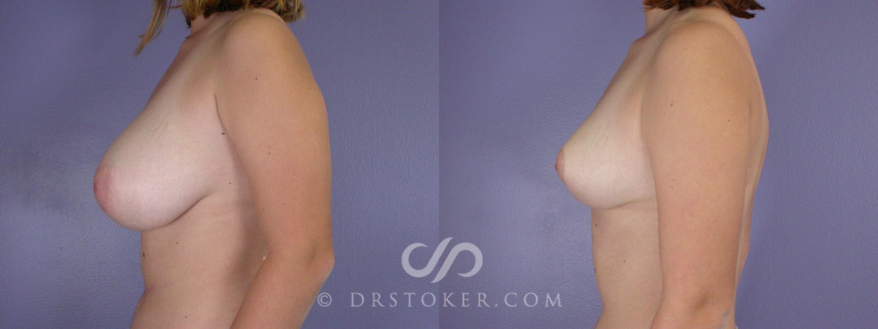 Before & After Breast Reduction (for Women) Case 216 View #5 View in Los Angeles, CA